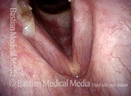 Image result for Reflux Laryngitis