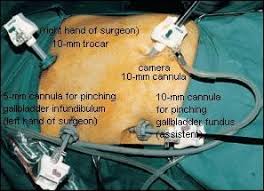 Gallbladder Removal Wounds Gallbladder Diverticulitis After Gallbladder Surgery