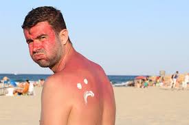 Image result for Sunburn