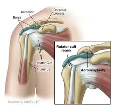 The biceps tendon begins at the top of the shoulder socket (the glenoid) and then passes across the front of the shoulder to connect to the biceps muscle. Rotator Cuff Tear Repair Lancaster Lebanon Pa