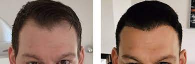 Kosten und nutzen der mittel gegen haarausfall und der haarverpflanzung vergleichen. Haartransplantation Forum Acura Plastische Chirurgie