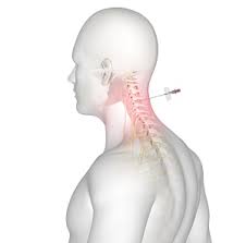 Image result for Lower Cervical Intramuscular Injection