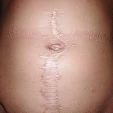 Check spelling or type a new query. Long Wait For Surgery Scars Girl For Life George Herald