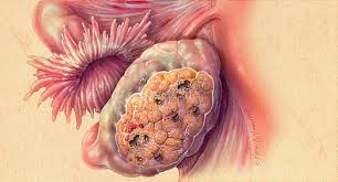 Common symptoms of ovarian cancer include bloating, pelvic pain, feeling full quickly, and urinary symptoms. Ovarian Cancer Pictures Cysts Symptoms Tests Stages And Treatments