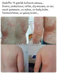 Lr Hayat Kalitenizi Arttirir Sedef Egzama Mantar Sackiran Saglik Sivilce Sacdokulmesi Kilo Agri Saglik Sac Dokulmesi Doktorlar