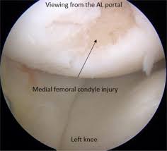 We did not find results for: Prevention Of Medial Femoral Condyle Injury By Using A Slotted Cannula In Anterior Cruciate Ligament Reconstruction Sciencedirect