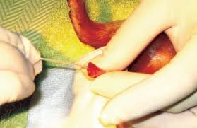 Image result for Urethral Catheterization