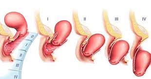 Prolapso Uterino Se Presenta Cuando Clinica Santa Maria Facebook