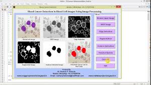 Bowel cancer is the 4th most common type of cancer. Matlab Project Blood Cancer Leukemia Cancer Detection Using Image Processing Ieee Based Project Youtube