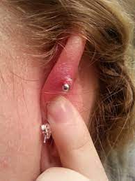 Sore Bump On The Back Of My Cartilage Piercing Beautylish