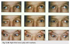 Image result for Pupillary Paralysis