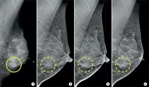 People should become familiar with the typical look and feel of their. 3 D Mammograms May Improve Accuracy Of Breast Cancer Screening