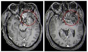 How to detect a brain tumor. Unusual Treatment Shows Promise For Kids With Brain Tumors