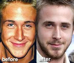 Ryan Gosling Plastic Surgery Before And After Celeb Surgery Celebrity Plastic Surgery Plastic Surgery Photos Cosmetic Surgery