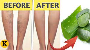 Pin On Varicose Veins