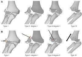 Image result for Lateral Condyle Fracture