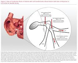 Image result for Left Bundle Branch Block