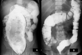 Image result for Fecal Incontinence