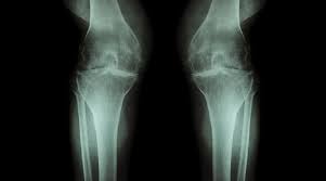 Lorsqu'on a de l'arthrose, on cherche des petites astuces pour aller mieux.pas besoin d'acheter des lors d'une crise d'arthrose, il est possible de soulager un peu les douleurs avec un ingrédient. Arthrose Ursachen Sympthome Und Prophylaxe