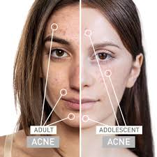 Adolescent acne affects 80% of people between 12- 24 years of age whereas  adult acne occurs in 45% of women over the age of 25! You can spot the  difference based on