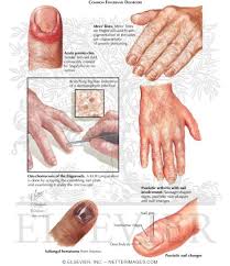 Nail Diseases And Disorders Lessons Tes Teach