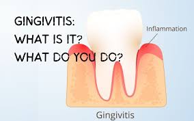 Image result for Gingivitis