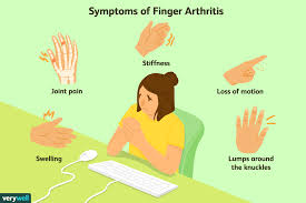 Finger Arthritis Signs Symptoms And Treatment