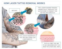 Laser beams use concentrated bursts of energy to heat up the ink beneath the skin, which breaks the ink into smaller particles. The Science Behind Laser Tattoo Removal How It Works Tattoodo