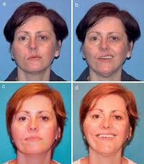 Bew ä hrte und innovative operative Techniken zur Reanimation des gel ä  hmten Gesichtes