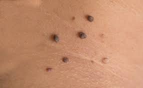 Dip a cotton ball in acv and press it against the affected area. How Hanging Moles Are Removed From The Skin Moles On Face Skin Tags Home Remedies Facial Moles