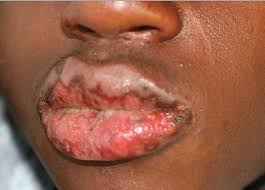 N engl j med 1995; Stevens Johnson Syndrome