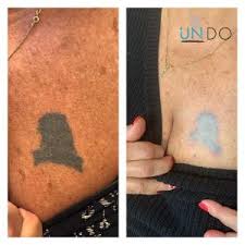 While tattoos may seem like a good idea at the time, many people eventually choose to have their tattoos removed. Undo Non Laser Tattoo Removal Boca Raton Fl Pittsburgh Pa
