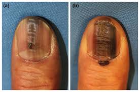 Image result for Acral lentiginous melanoma nail