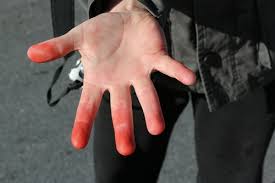 Image result for Frostbite