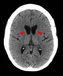Huntington Disease Neurology Medbullets Step 2 3