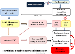 Image result for Delayed Transition from Fetal Circulation