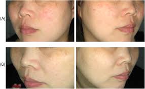 Telangiectasia treatment in an Asian woman. Pictures with polarized...