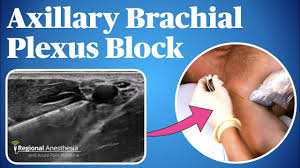 Image result for Axillary Nerve Block