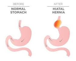 Image result for stomach hernia symptoms