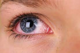 We consulted experts on the best ways to get rid of red eyes, from the best eye drops, compresses, and supplements to solve the problem, including lumify eye drops and areds eye supplements. Why Are My Eyes Always Red Health Essentials From Cleveland Clinic