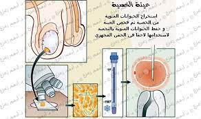 عينة الخصية وطرق استخراج الحيوانات المنوية comics diagram vei