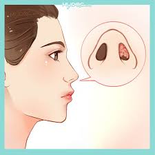 To remove polyps from the nasal passage. Best Nasal Polyps Surgery In Malaysia Price Guide Reviews