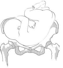 Image result for Shoulder Presentation