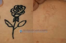 This client did 2 treatments with us (sorry we don't have a photo of the progress before the don't live with tattoos you don't love! Tattoo Removal Washington Dc Center For Laser Surgery