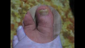 toenail fungus after several months