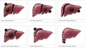 Check spelling or type a new query. Robotic Liver Surgery Intechopen
