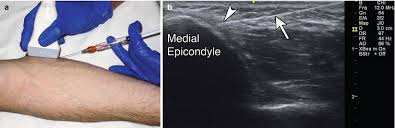 Image result for Epicondyle Injection
