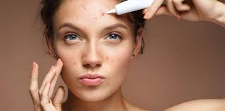 Image result for acne face