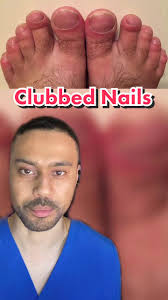 Image result for Clubbing nails feet