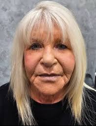 Picked a surgeon! Scheduled for March 12th. DP FL/NL, browlift with fat  transfer. Picking the surgeon is the hardest! I came across several  surgeons that I was impressed with! Nervous now about